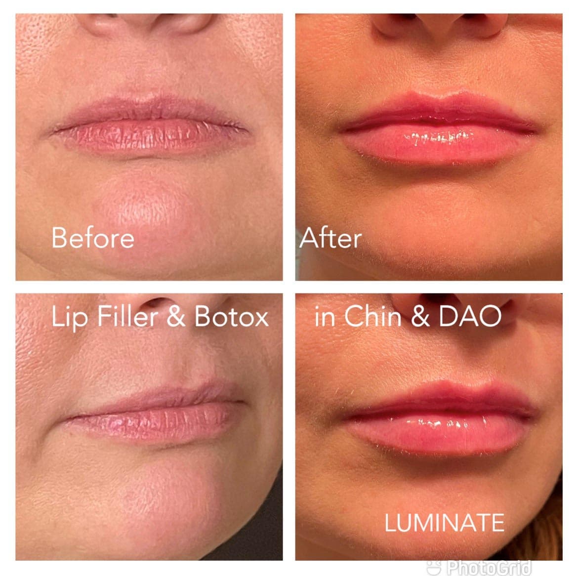 Before and After result for Botox/Dysport treatment patient 1 at Luminate Clinic