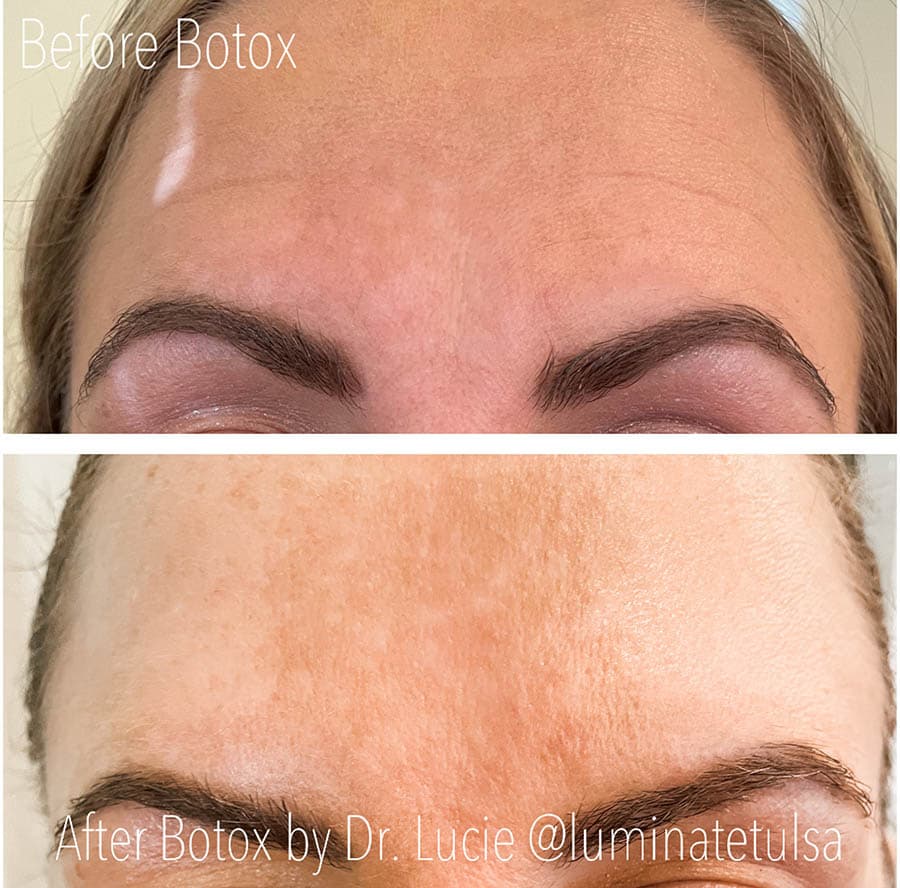 Before and After result for Botox/Dysport treatment patient 3 at Luminate Clinic
